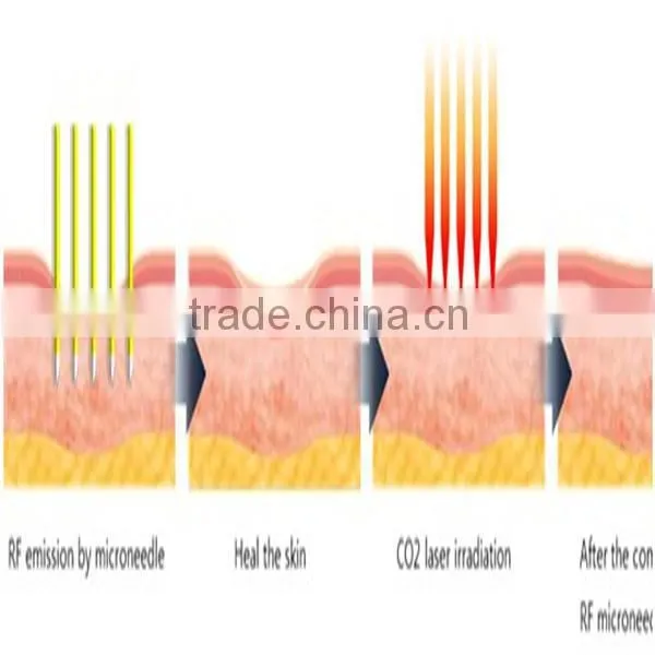 Fast skin rejuvenation and tightening beauty machine portable intracel fractional rf microneedle