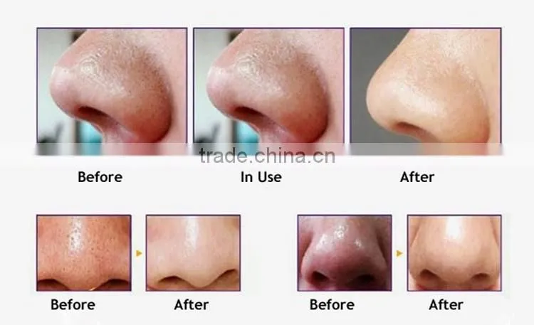 Rechargeable Diamond Microdermabrasion Machine Vacuum Blackhead Suction Pores Cleaning Machine for Skin Cleaning