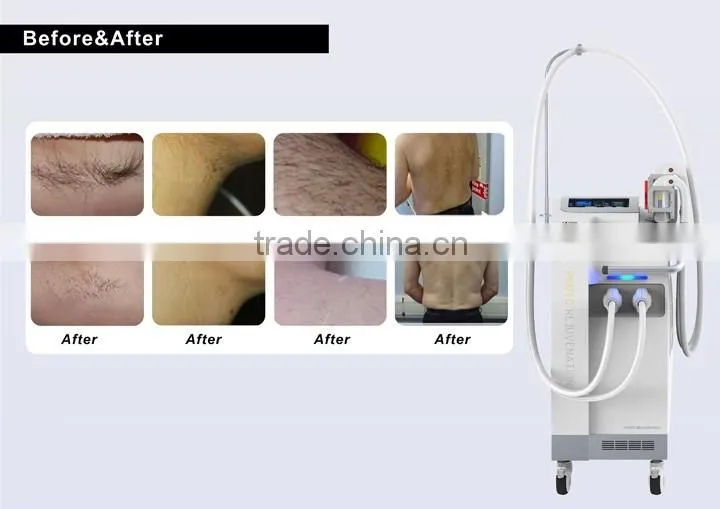 painless hair removal elight RFipl laser hair removal machine for sale--DORA-I new year promotion