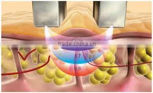 aribaba vacuum massage machine with rf made in China