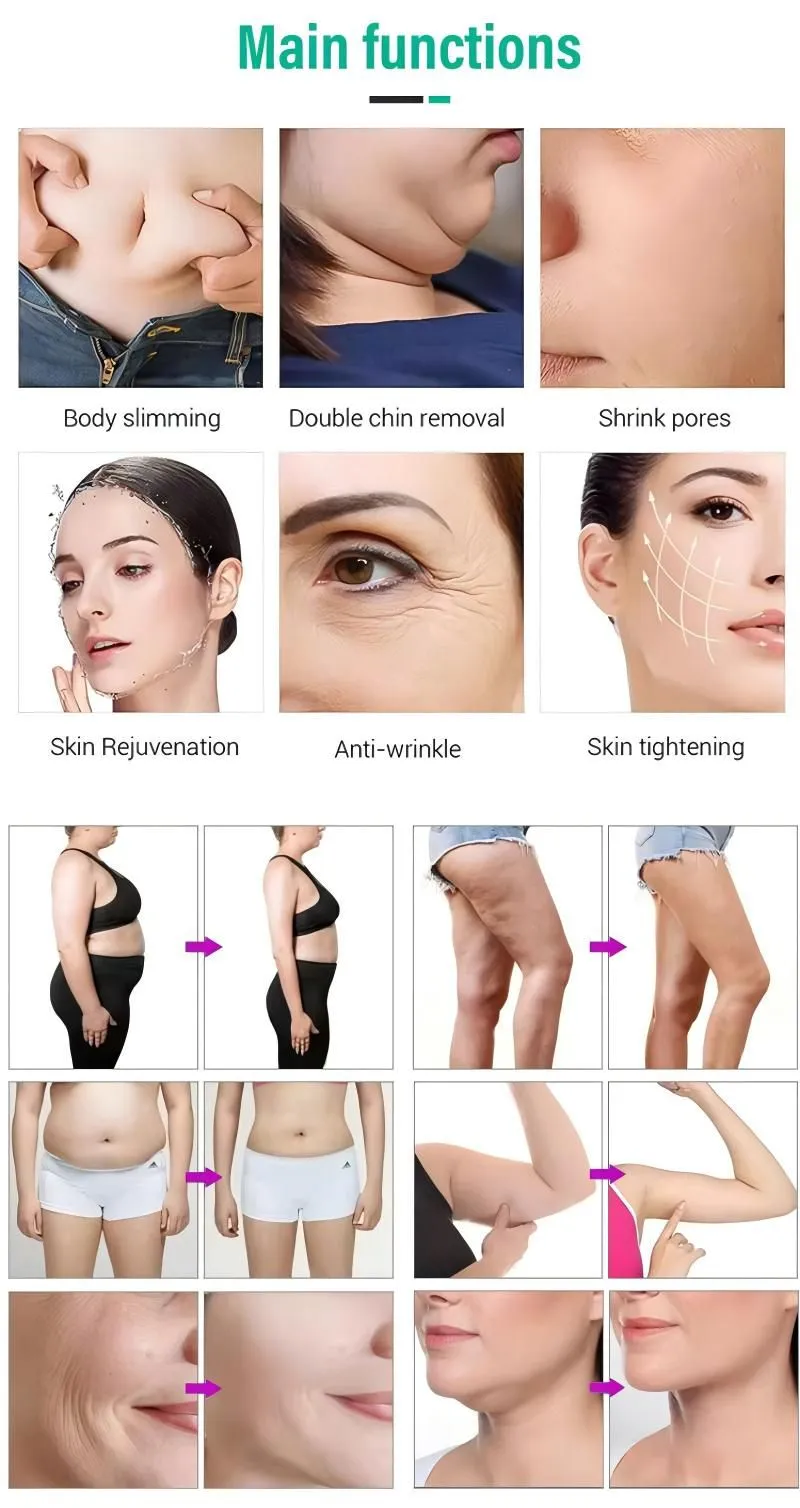 cryolipolysis1.jpg.webp
