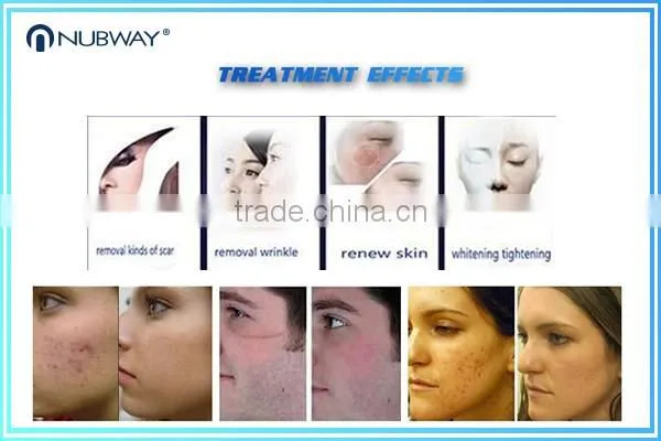 Hottest sale !!!!! skin renewal acne wrinkles removal ultrapulse fractional co2 laser