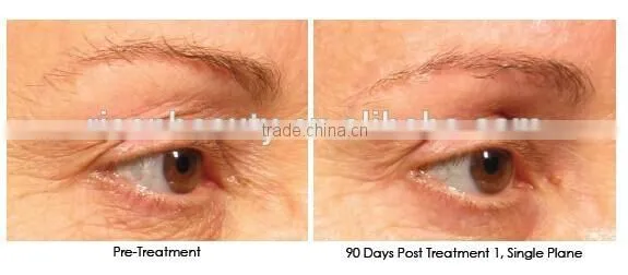 dermapen needles/electric hot sale 12 needls dermapen
