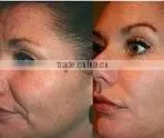 the lasest technology yag laser hair removal machine