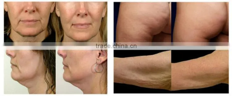 best non surgical bipolar RF microcurrent face lift home machine