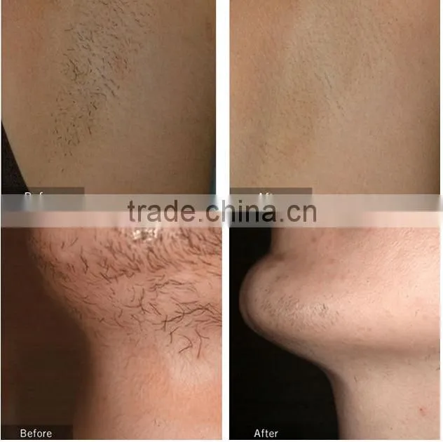 Factory promotion IPL RF skin rejuvenation OPT& E-light hair removal system