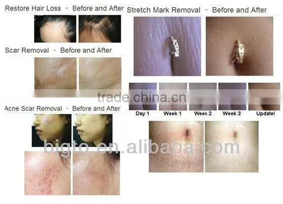 1080 derma roller acne scar removal microneedle titanium dermaroller