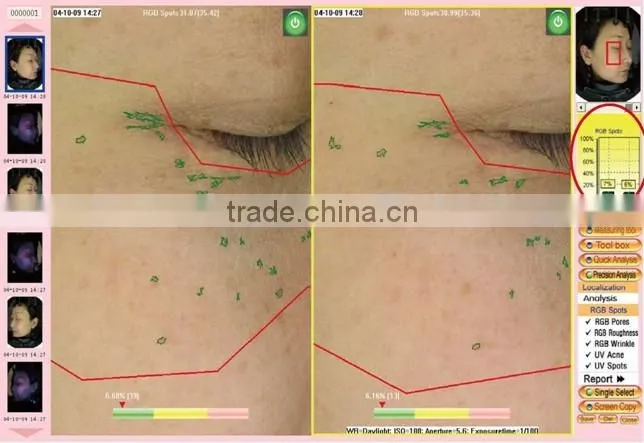 Skin Analyzer Type Portable Digital Skin analyzer
