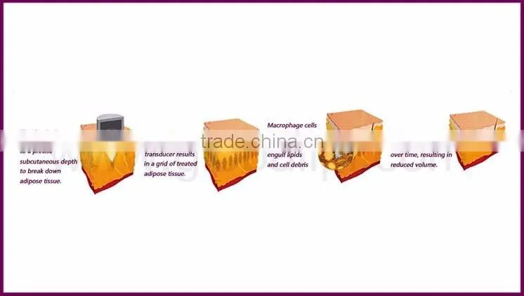 Advanced HIFU Technology / HIFUshape / HIFU Body Slimming