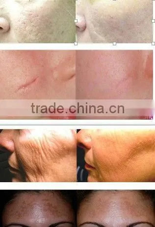 Top quality Doctor Use ,CO2 fractional laser skin rejuvenation