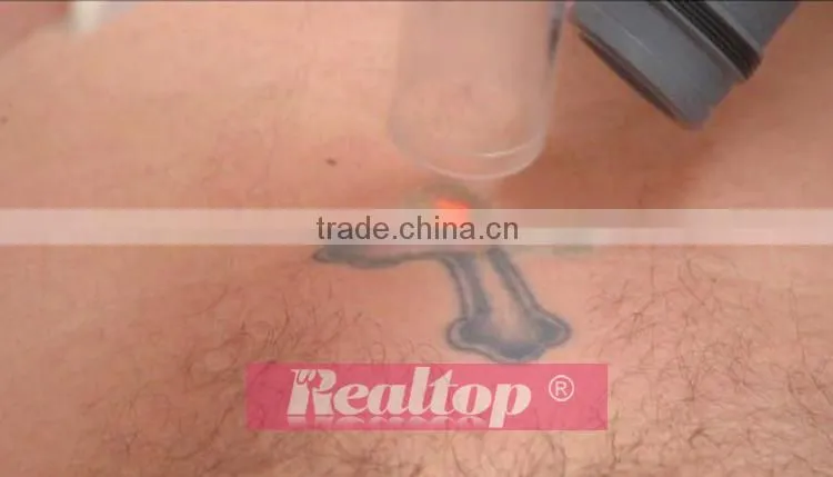 We looking for distributor q-switched nd:yag skin whitening & remove permanent tattoo machine / laser tatto removal machine