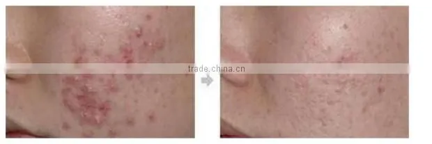 Face Lifting Skin Peeling Facial Bubble Machine Skin Rejuvenation