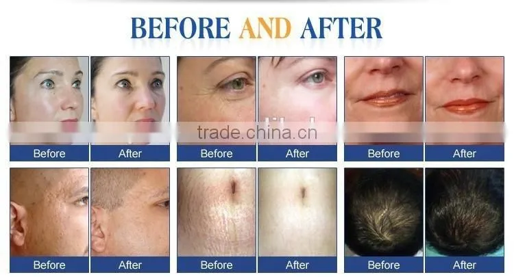 Hot sale Skin care dermaroller 540 needles derma skin roller microneedling dermaroller