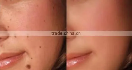 freckle removal laser pen freckle remover removel