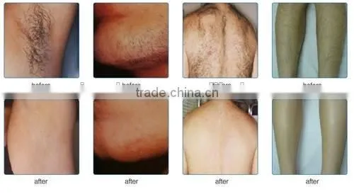 FDA IPL SHR OPT Hair Removal skin rejuvenation beauty salon machine with factory price