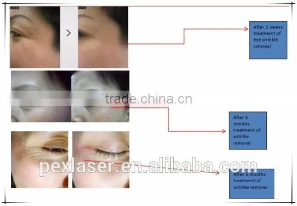 Eye Wrinkle Treatment RF eye lift machine