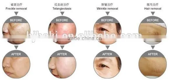 The latest technology ipulse ipl
