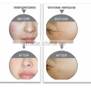 SUSLASER Elight Laser Hair Removal Machine thumbnail-5
