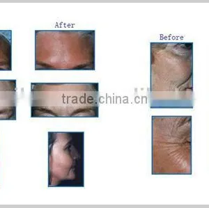 Hot Selling YUWEI Facial Skin Care Lifting Eye Wrinkle Removal Eye Care Massage thumbnail-6