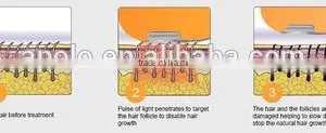 Hot Sale Apolomed HS-310C Multifunction Ipl thumbnail-4