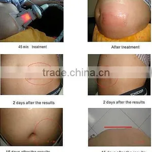 Fat Reduce Cooling Slimming Weight Loss Zeltiq Machine Cryolipolysis Fat Reducing thumbnail-6