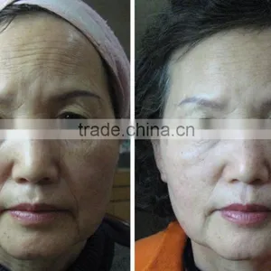 High Frequency Operation System and Anti-Puffiness/Skin Tightening/Wrinkle Remover Feature HIFU Face Lift thumbnail-3