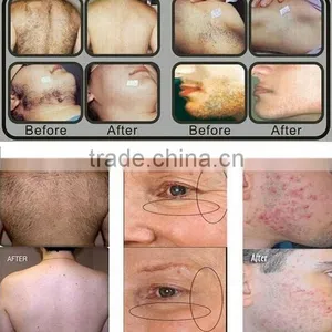 Alexandrite Laser no Pain Strong Power Hair Removal Machine 808 Diode Face Body Hair Rmeoval thumbnail-6