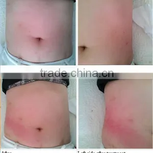 SUS 650nm Lipo Laser Fat Removal Machine/ Laser Slimming Machine thumbnail-5
