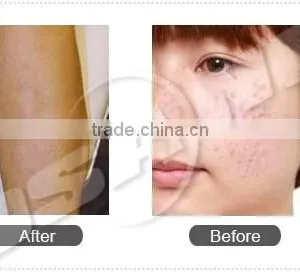 1 HZ 2015 Laser Tattoo Laser Removal Tattoo Machine Removal Machine Price Vascular Tumours Treatment thumbnail-6