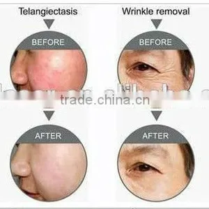 755+1064 Alexandrite Laser Permanent Hair Removal Machine Pigmentation Correctors thumbnail-3