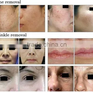 Sun Damage Recovery RF Co2 Laser /RF Metal Tube Fractional Co2 8.0 Remove Neoplasms Inch Laser Machine With Vaginal Tightening / Rf Tube CO2 thumbnail-2