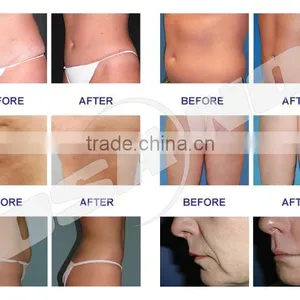 New Products Slimming Criolipolisis Machine Weight Lossing , Criolipolisys Fat Freezing Machine thumbnail-6