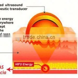 2016 FU4.5-4S Portable Hifu/hifu High Intensity Focused Ultrasound thumbnail-4