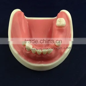 Medical Science Dental Implant Model With Soft Gingiva thumbnail-4
