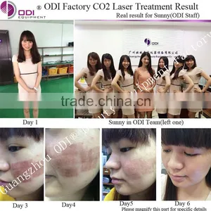 35%OFF! New Laser Co2 Fractional for Wrinkle Removal and Skin Resurfacing thumbnail-4