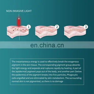 Single Handle Non-invasive Tattoo Removal Laser Machine Q Switch Nd Yag Laser Eyebrow Washing Instrument Pigment Spot Removal thumbnail-5