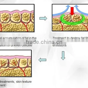 10MHz Approved Vacuum RF Liposuction Cavitation Slimming Machine Ultrasonic Cavitation System Skin Rejuvenation thumbnail-5
