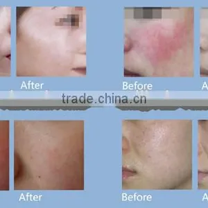 Beauty & Personal Care 980nm Diode Laser Spider Vein Removal Machine Vascular Remover thumbnail-6