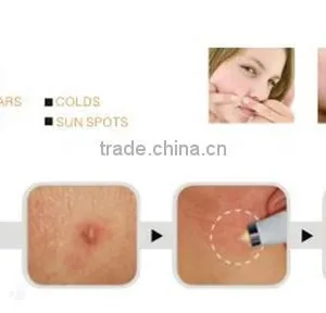 Best Effective Hot Sale Soft Acne Laser Removal/acne Treatments Pen for Sale thumbnail-5