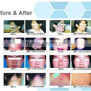 2016 Latest Laser Co2 Fractional / Co2 Fractional Laser / Co2 Laser thumbnail-5