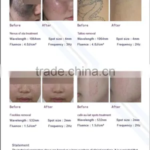 Professional Germany Laser Tan Removal Machine/skin Type Mongolian Spots Removal Vertical Nd Yag Laser Hair Removal Machine Q Switched Nd Yag Laser Tattoo Removal Machine thumbnail-5