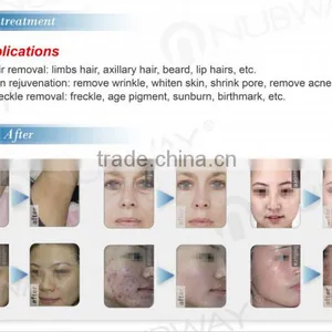 SHR IPL Elight Acne Scar Removal Machine/ Home Permanent Hair Removal thumbnail-4