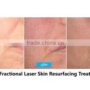 Laser Type and Fractional Laser,CO2 Laser Laser Type Medical Surgery(Clinic Use) Without Pain thumbnail-6