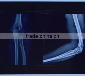 Hot Blue Film Free Blue Thermal Film Medical(12*14) X-ray Blue Film thumbnail-6