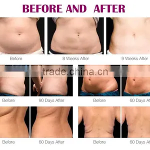 5 In 1 Ultrasonic Rf Cavitation Slim N Lift Ultrasonic Weight Loss Machine Body Shaper Fitness Machines Body Shaper Slimming Body Shaping thumbnail-3