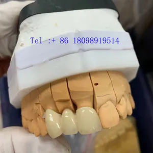 Expander Orthodontic in China Dental Lab thumbnail-1