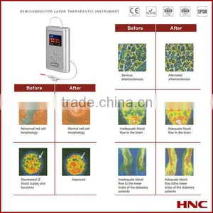 SECO Laser Blood Purifier Hubei thumbnail-1