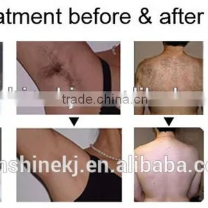 Most Popular SHR OPT IPL for Hair Removal thumbnail-4