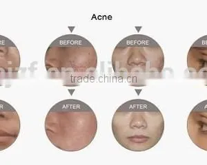 Freckle and Nevus Removal Machine From Beijing Anybeauty Company thumbnail-6
