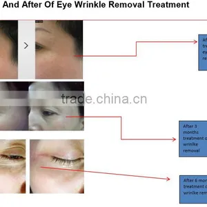 Beauty Machine Eye Care System for Eye Bag Removal for Wrinkle Removal thumbnail-5